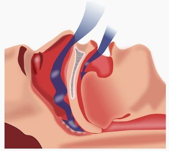 Webconférence du 17 novembre : Fibrose Pulmonaire et Apnée du Sommeil