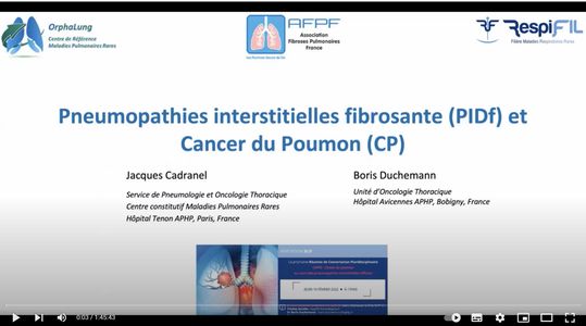 Pneumopathies interstitielles fibrosantes et cancer du Poumon    